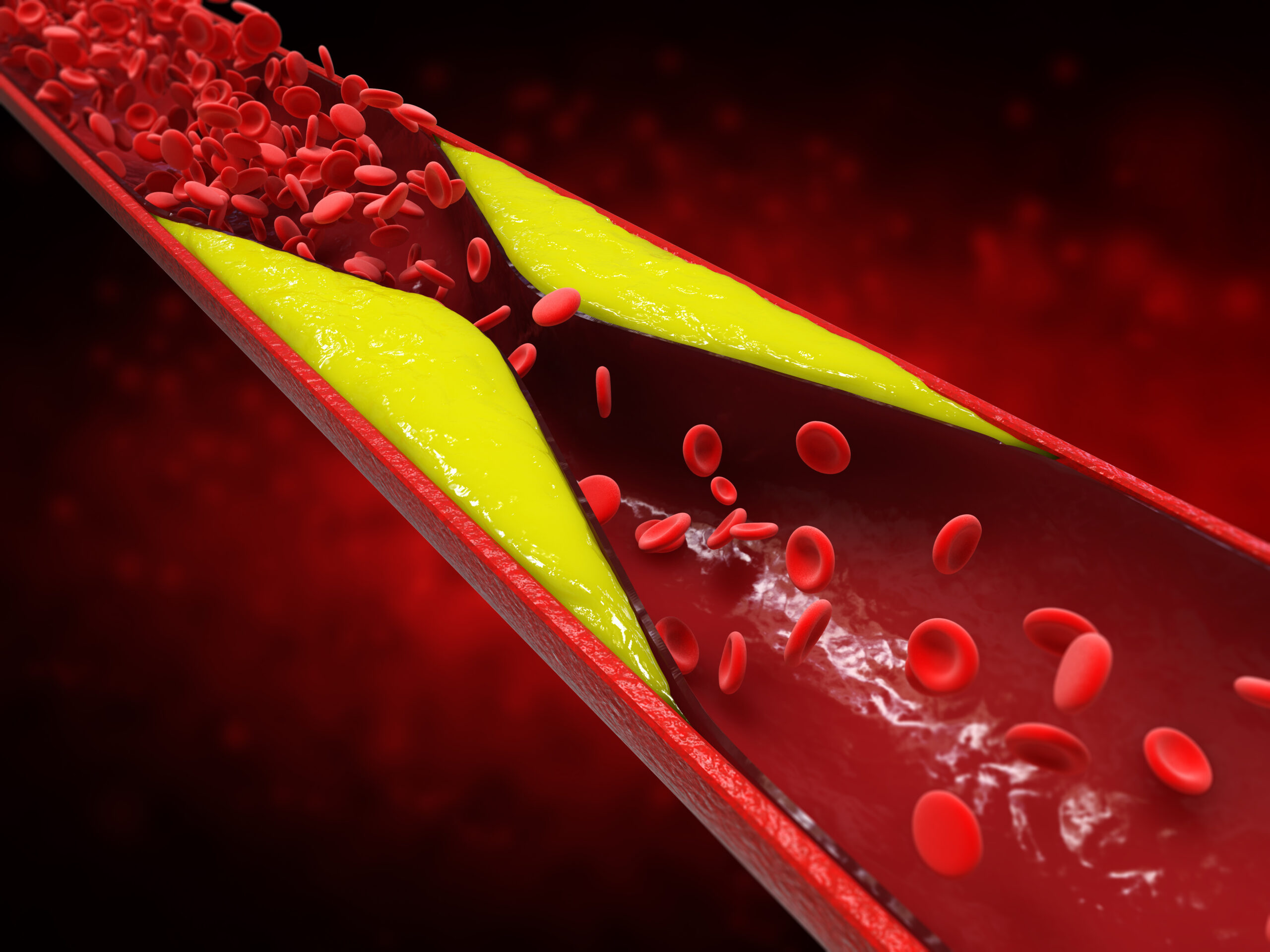 Chronic Total Occlusion & High Risk Coronary Interventional Clinic